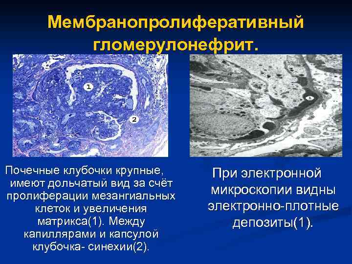 Мембранопролиферативный гломерулонефрит. Почечные клубочки крупные, имеют дольчатый вид за счёт пролиферации мезангиальных клеток и