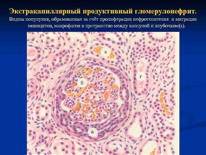 Экстракапиллярный продуктивный гломерулонефрит. Видны полулуния, образованные за счёт пролиферации нефротепителия и миграции моноцитов, макрофагов