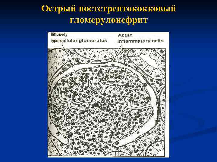 Острый постстрептококковый гломерулонефрит 