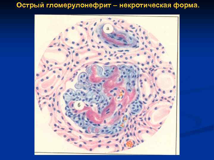 Острый гломерулонефрит – некротическая форма. 