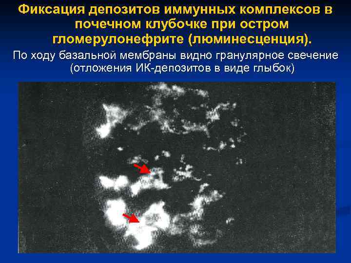 Фиксация депозитов иммунных комплексов в почечном клубочке при остром гломерулонефрите (люминесценция). По ходу базальной