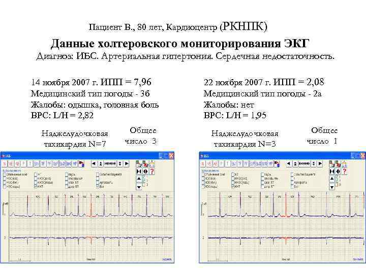 Пациент В. , 80 лет, Кардиоцентр (РКНПК) Данные холтеровского мониторирования ЭКГ Диагноз: ИБС. Артериальная