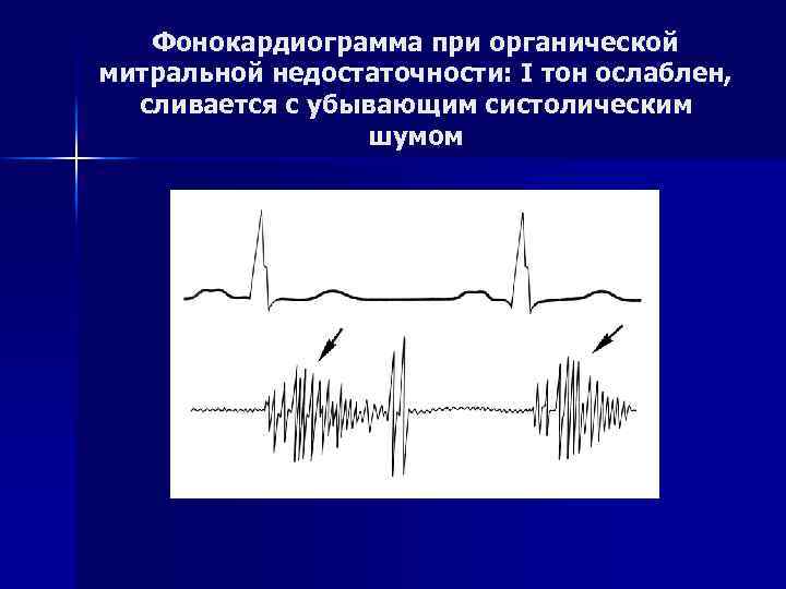 Фонокардиограмма при органической митральной недостаточности: I тон ослаблен, сливается с убывающим систолическим шумом 