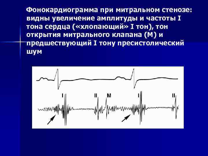 Фонокардиограмма при митральном стенозе: видны увеличение амплитуды и частоты I тона сердца ( «хлопающий»