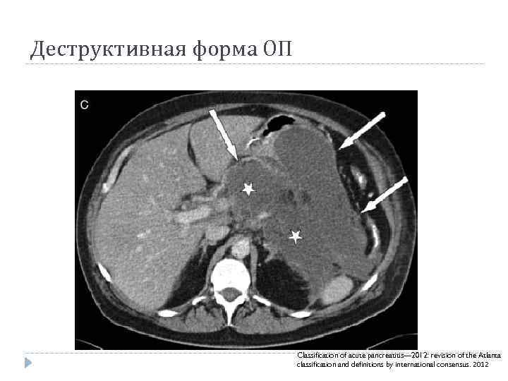 Деструктивная форма ОП Classification of acute pancreatitis— 2012: revision of the Atlanta classification and
