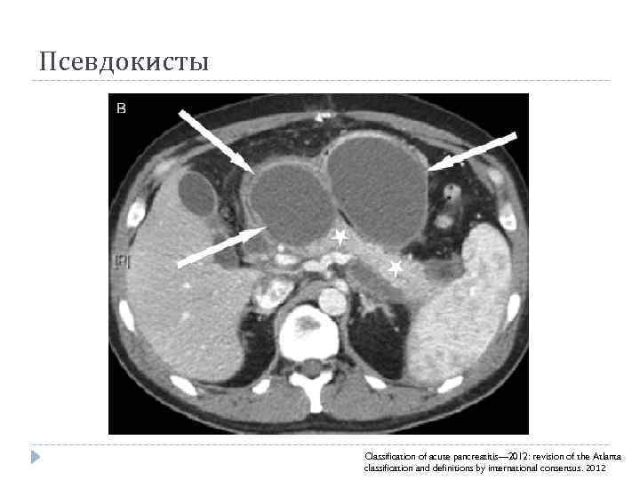 Псевдокисты Classification of acute pancreatitis— 2012: revision of the Atlanta classification and definitions by