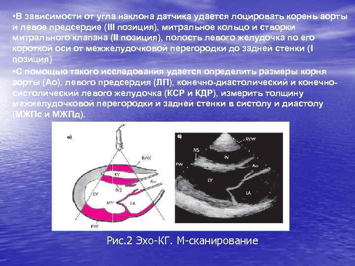  • В зависимости от угла наклона датчика удается лоцировать корень аорты и левое