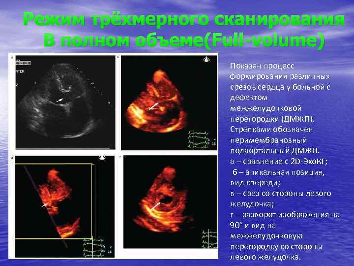 Режим трёхмерного сканирования В полном объеме(Full-volume) Показан процесс формирования различных срезов сердца у больной