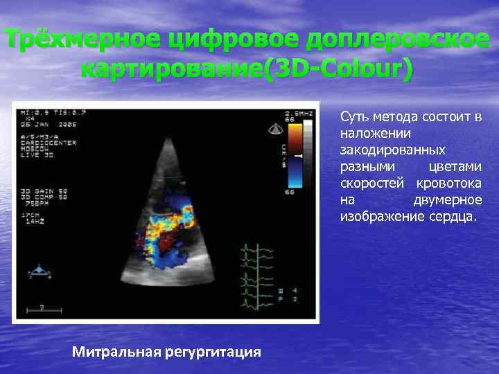 Регургитация 1 форум. Цифровое допплеровское картирование. Скорость трикуспидальной регургитации. Доплеровское исследование при ЭГС. Vena contracta аортальная регургитация.