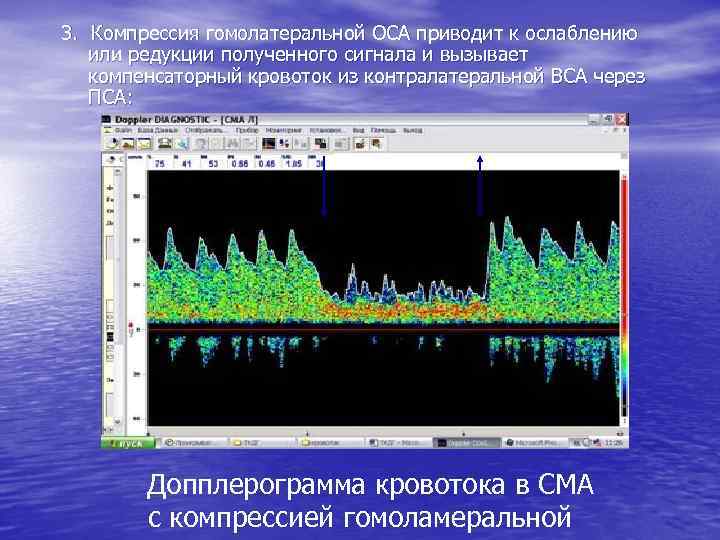 3. Компрессия гомолатеральной ОСА приводит к ослаблению или редукции полученного сигнала и вызывает компенсаторный