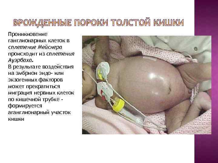 ВРОЖДЕННЫЕ ПОРОКИ ТОЛСТОЙ КИШКИ Проникновение ганглионарных клеток в сплетение Мейснера происходит из сплетения Ауэрбаха.