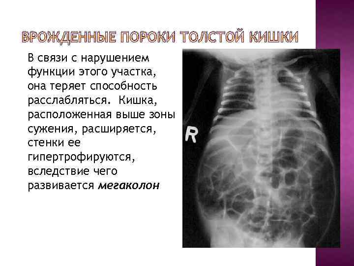 ВРОЖДЕННЫЕ ПОРОКИ ТОЛСТОЙ КИШКИ В связи с нарушением функции этого участка, она теряет способность