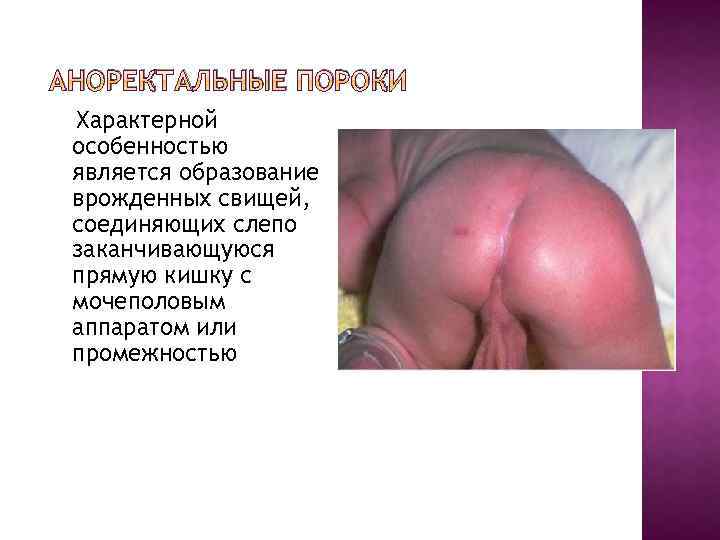 АНОРЕКТАЛЬНЫЕ ПОРОКИ Характерной особенностью является образование врожденных свищей, соединяющих слепо заканчивающуюся прямую кишку с