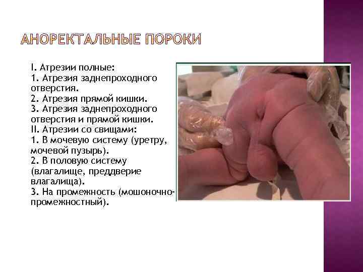 I. Атрезии полные: 1. Атрезия заднепроходного отверстия. 2. Атрезия прямой кишки. 3. Атрезия заднепроходного