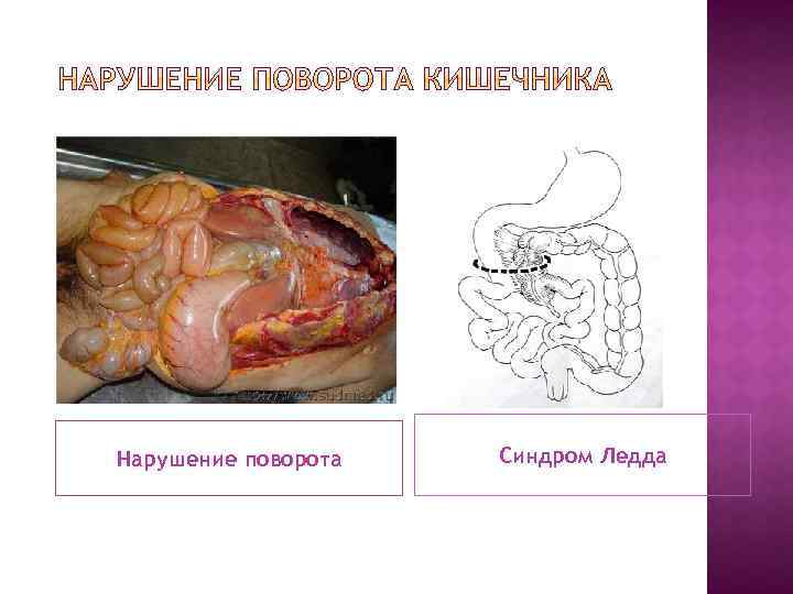 Нарушение поворота Синдром Ледда 