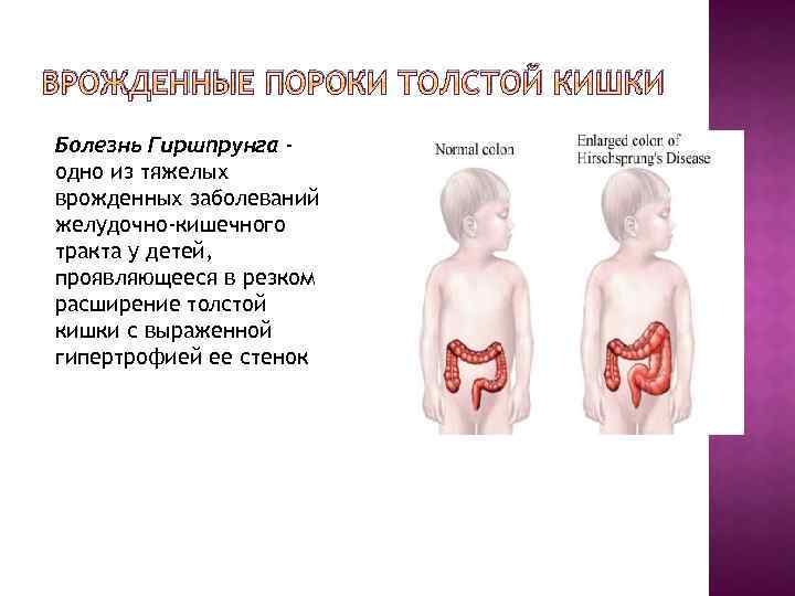 ВРОЖДЕННЫЕ ПОРОКИ ТОЛСТОЙ КИШКИ Болезнь Гиршпрунга одно из тяжелых врожденных заболеваний желудочно-кишечного тракта у