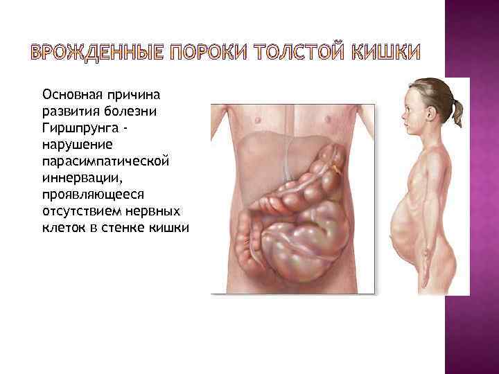 ВРОЖДЕННЫЕ ПОРОКИ ТОЛСТОЙ КИШКИ Основная причина развития болезни Гиршпрунга нарушение парасимпатической иннервации, проявляющееся отсутствием