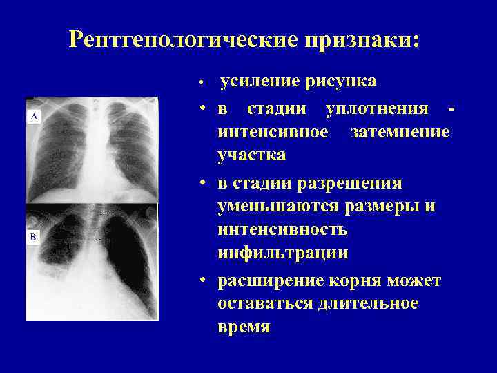 Рентгенологические признаки: • усиление рисунка • в стадии уплотнения интенсивное затемнение участка • в