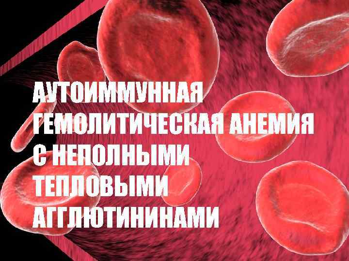 АУТОИММУННАЯ ГЕМОЛИТИЧЕСКАЯ АНЕМИЯ С НЕПОЛНЫМИ ТЕПЛОВЫМИ АГГЛЮТИНИНАМИ 