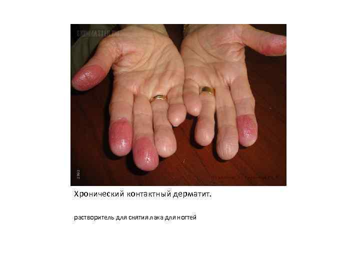 Хронический контактный дерматит. растворитель для снятия лака для ногтей 