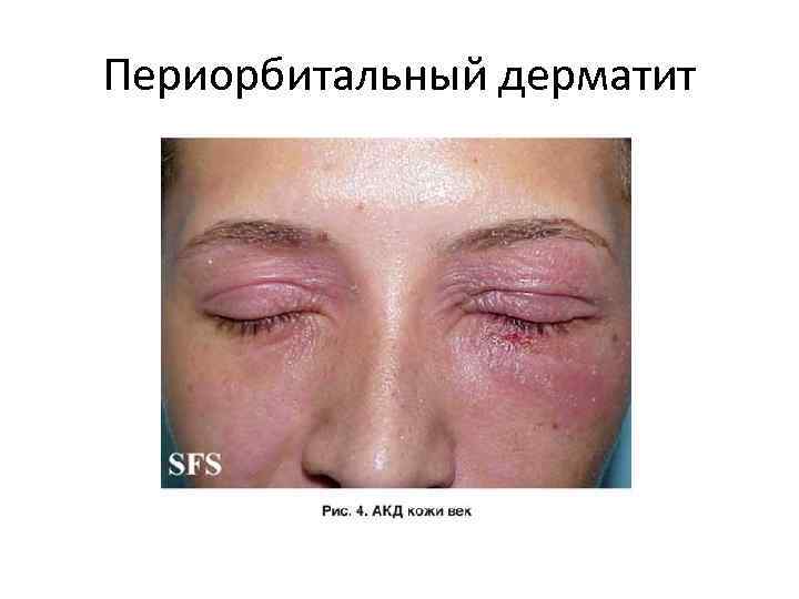 Презентация на тему аллергический дерматит thumbnail