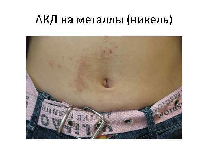 АКД на металлы (никель) 