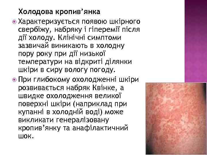 Холодова кропив’янка Характеризується появою шкірного свербіжу, набряку і гіперемії після дії холоду. Клінічні симптоми