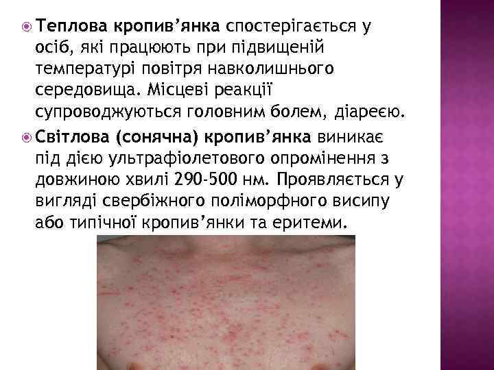  Теплова кропив’янка спостерігається у осіб, які працюють при підвищеній температурі повітря навколишнього середовища.