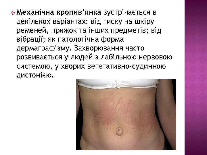  Механічна кропив’янка зустрічається в декількох варіантах: від тиску на шкіру ременей, пряжок та