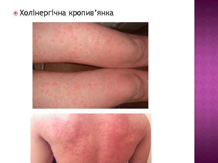  Холінергічна кропив’янка 