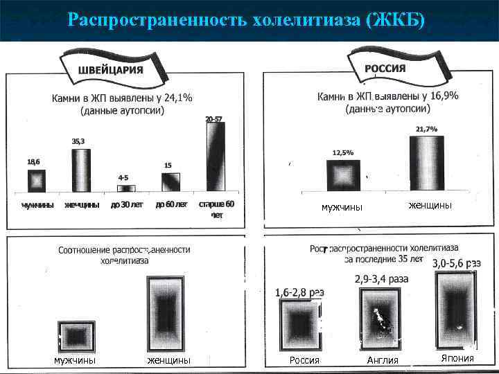 Распространенность холелитиаза (ЖКБ) женщины мужчины женщины Россия Англия Япония 
