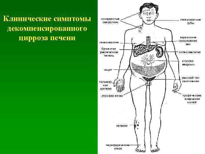 Признаки печени симптомы. Значимый клинический признак цирроза печени. Клинические симптомы цирроза печени. Основные клинические проявления цирроза печени. Клинические проявления при циррозе печени.