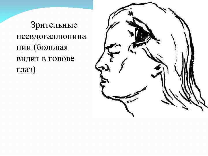 Зрительные псевдогаллюцина ции (больная видит в голове глаз) 