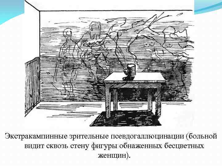 Экстракампинные зрительные псевдогаллюцинации (больной видит сквозь стену фигуры обнаженных бесцветных женщин). 