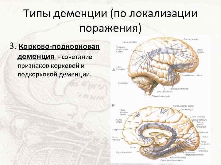 Типы деменции (по локализации поражения) 3. Корково-подкорковая деменция - сочетание признаков корковой и подкорковой