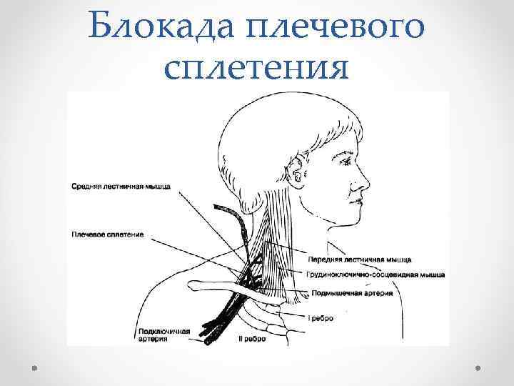 Блокада плечевого сплетения 
