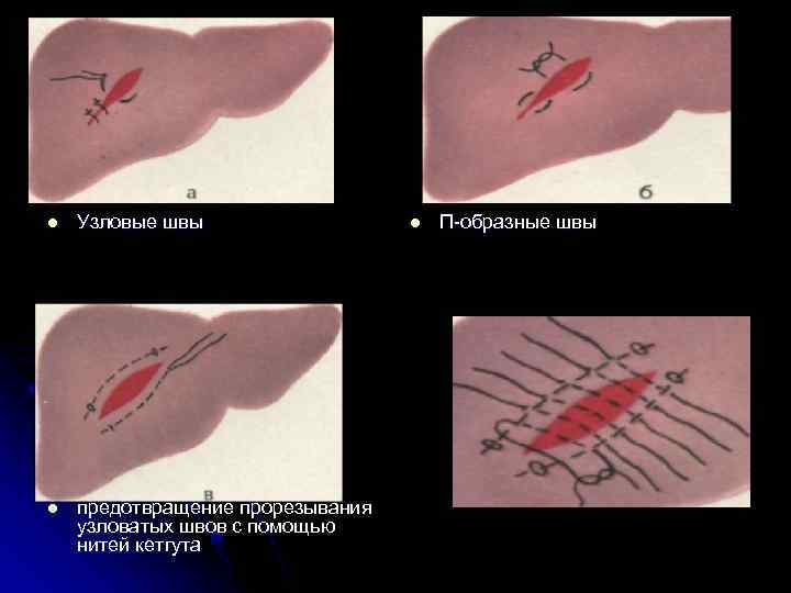 l Узловые швы l предотвращение прорезывания узловатых швов с помощью нитей кетгута l П-образные