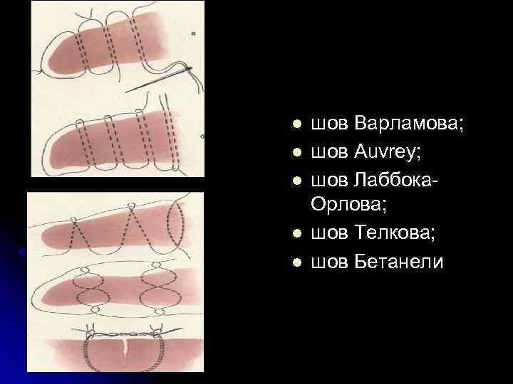 l l l шов Варламова; шов Auvrey; шов Лаббока. Орлова; шов Телкова; шов Бетанели