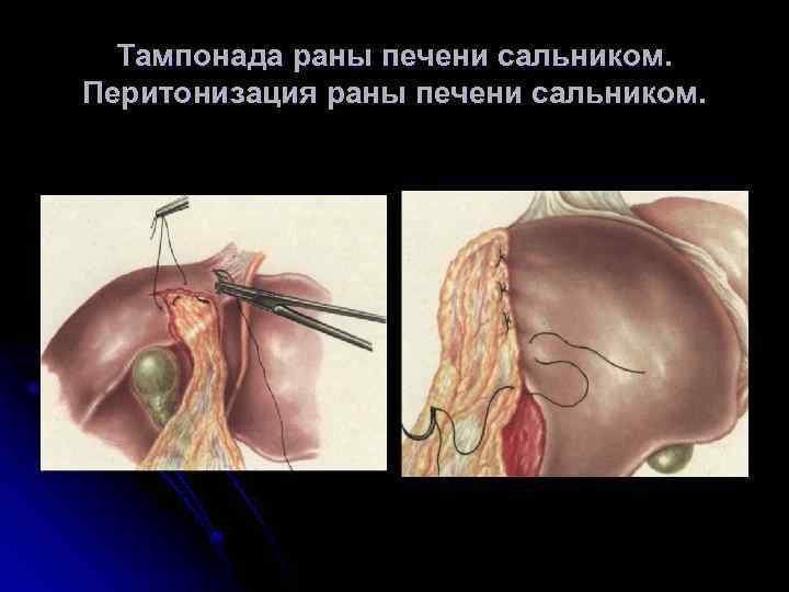 Тампонада раны печени сальником. Перитонизация раны печени сальником 