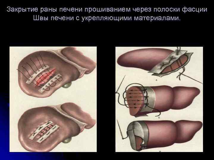 Закрытие раны печени прошиванием через полоски фасции Швы печени с укрепляющими материалами. 