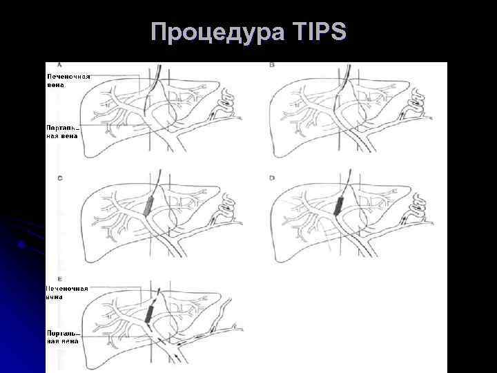 Процедура TIPS 