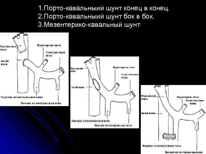 1. Порто-кавальныий шунт конец в конец. 2. Порто-кавальныий шунт бок в бок. 3. Мезентерико-кавальный