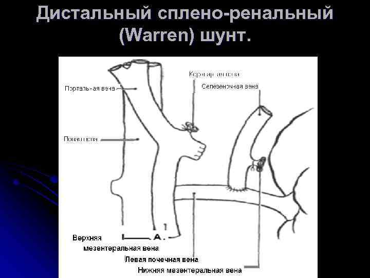 Дистальный сплено-ренальный (Warren) шунт. 