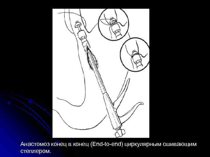 Анастомоз конец в конец (End-to-end) циркулярным сшивающим степлером. 