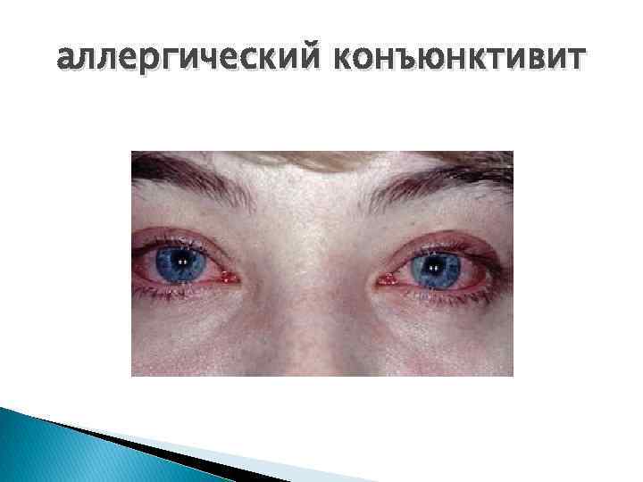 аллергический конъюнктивит 