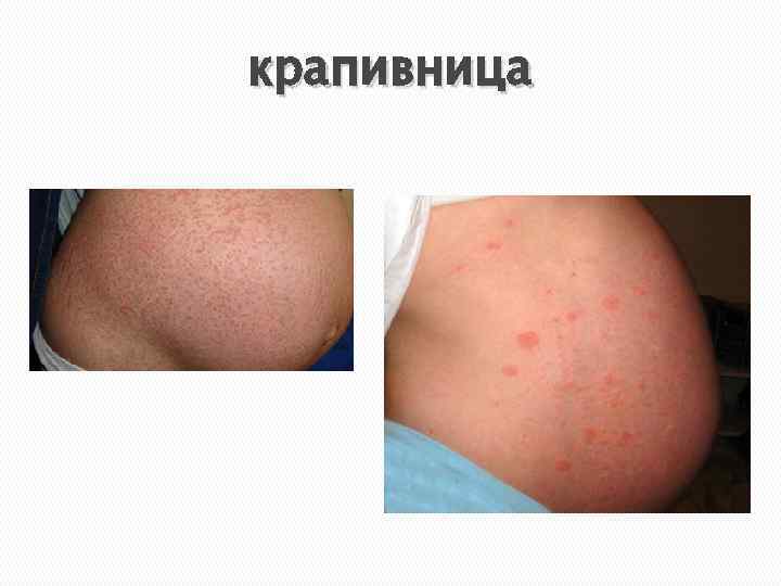 крапивница 