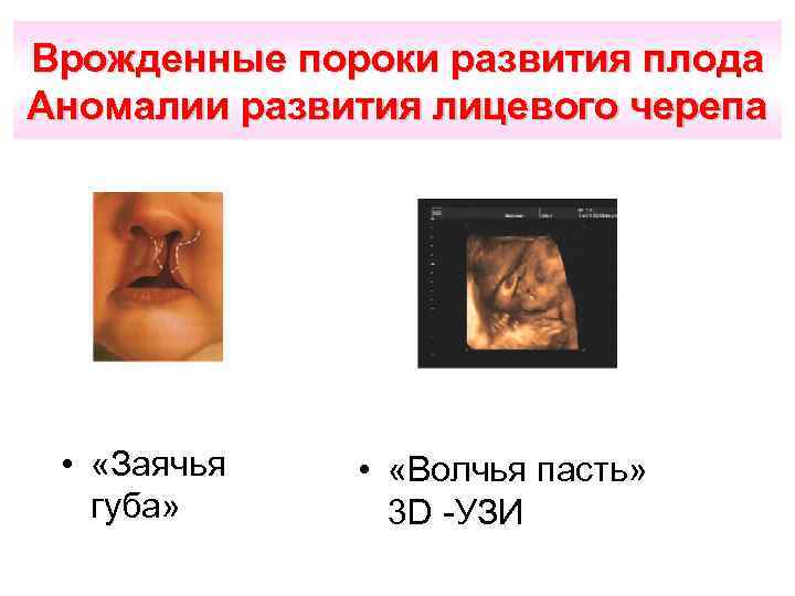 Врожденные пороки развития плода Аномалии развития лицевого черепа • «Заячья губа» • «Волчья пасть»