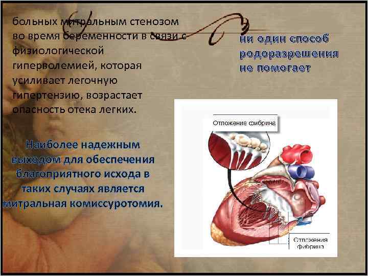 больных митральным стенозом во время беременности в связи с физиологической гиперволемией, которая усиливает легочную