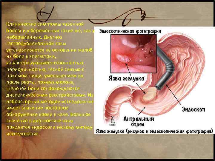 Клинические симптомы язвенной болезни у беременных такие же, как у небеременных. Диагноз гастродуоденальной язвы