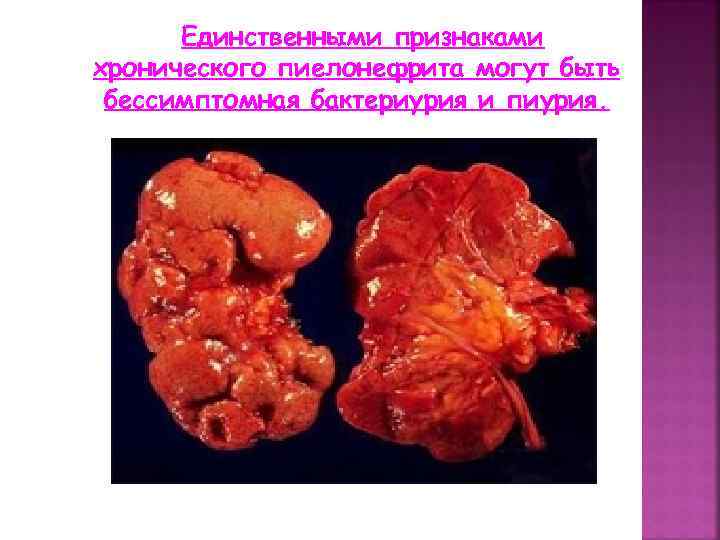 Единственными признаками хронического пиелонефрита могут быть бессимптомная бактериурия и пиурия. 